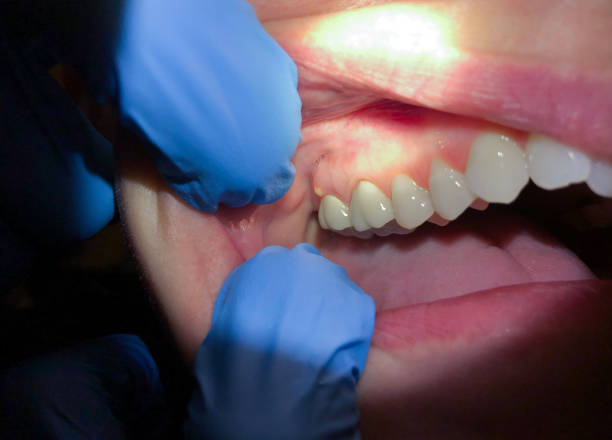 Best Emergency Dental Care for Broken or Chipped Teeth in Texanna, OK