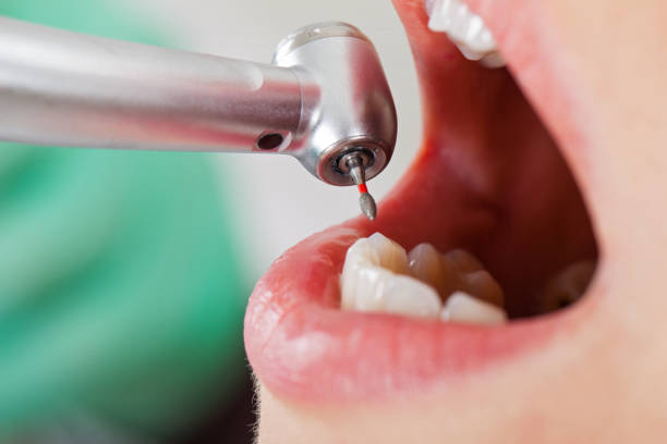 Best Emergency Wisdom Teeth Removal in Texanna, OK